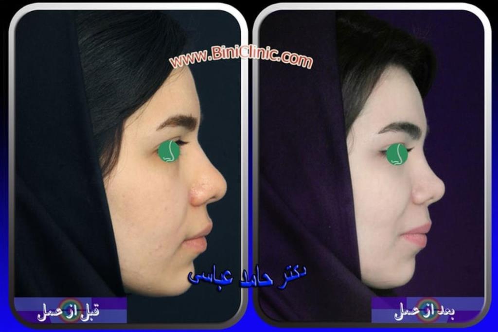 هر آنچه که باید در مورد عمل بینی گوشتی بدانید