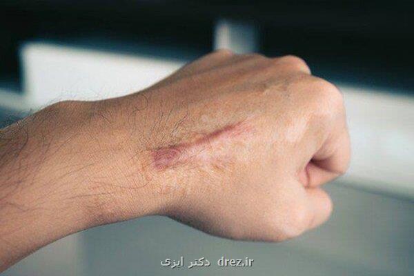راه های درمان کلوئید