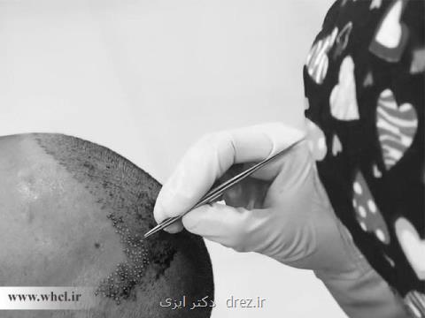 عوارض كاشت مو