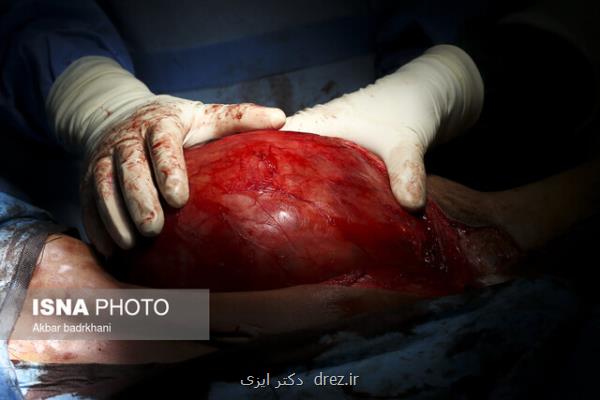 برداشتن توده ۹ كیلویی از بدن بیمار ۷۸ ساله در بیمارستان شهید بهشتی یاسوج